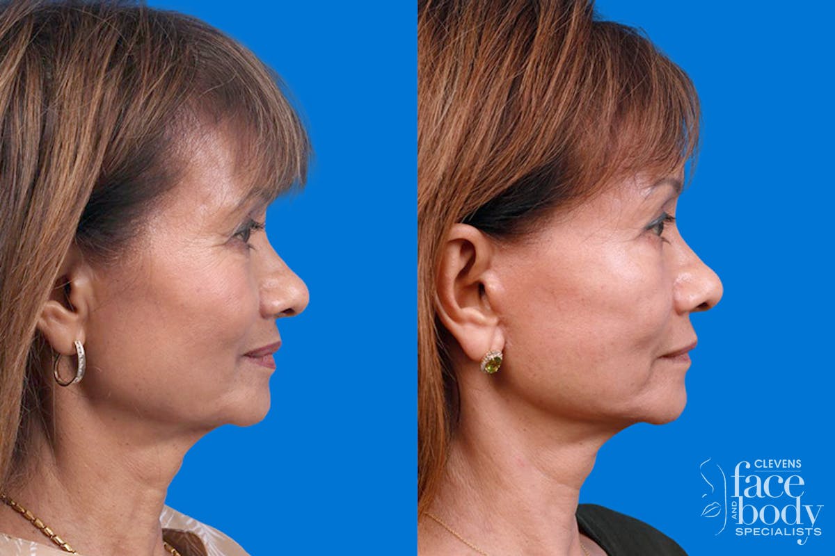 Eyelid Surgery Before & After Gallery - Patient 189262 - Image 3