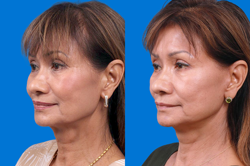Facelift Before & After Gallery - Patient 179167387 - Image 4