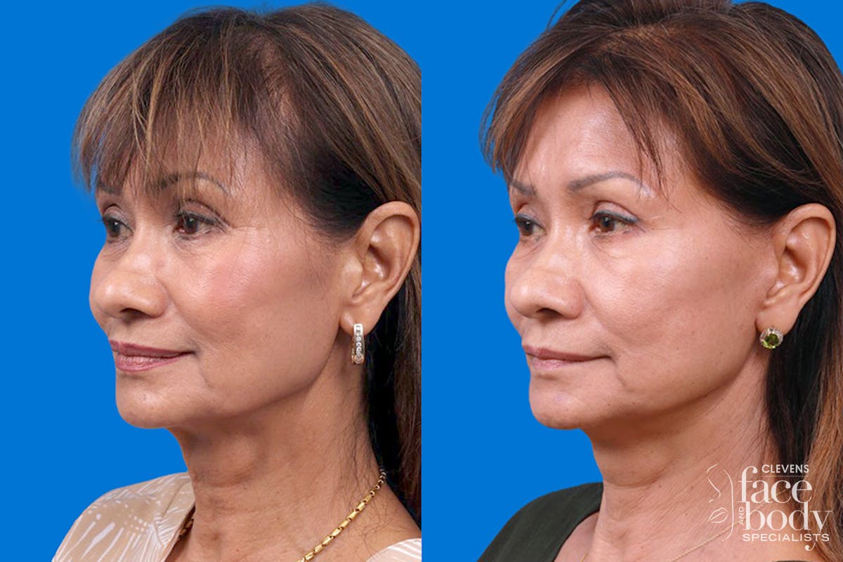 Eyelid Surgery Before & After Gallery - Patient 189262 - Image 4
