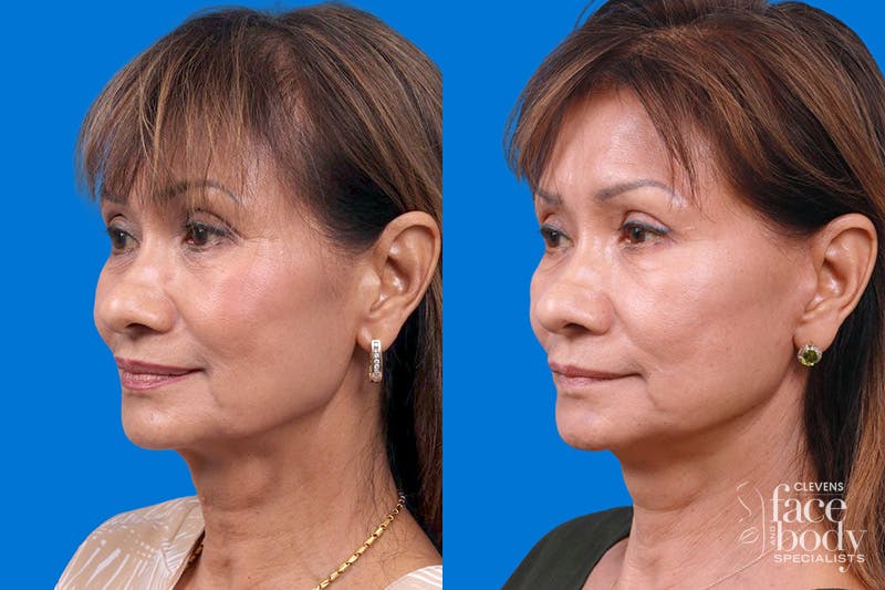 Eyelid Surgery Before & After Gallery - Patient 189262 - Image 4