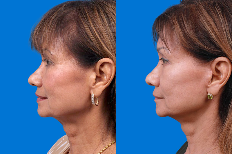 Facelift Before & After Gallery - Patient 179167387 - Image 5