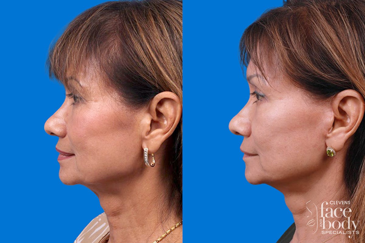 Eyelid Surgery Before & After Gallery - Patient 189262 - Image 5