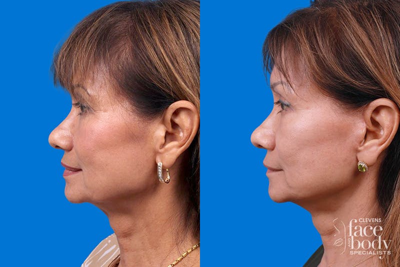 Eyelid Surgery Before & After Gallery - Patient 189262 - Image 5