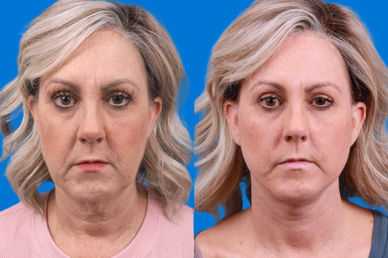 Facelift Before & After Gallery - Patient 147033236 - Image 1