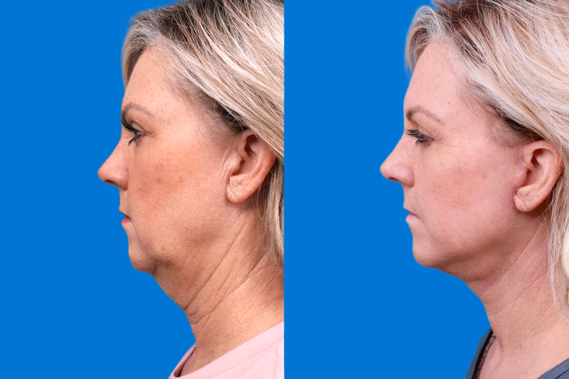 Facelift Before & After Gallery - Patient 147033236 - Image 5