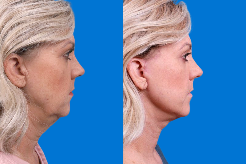 Facelift Before & After Gallery - Patient 147033236 - Image 3