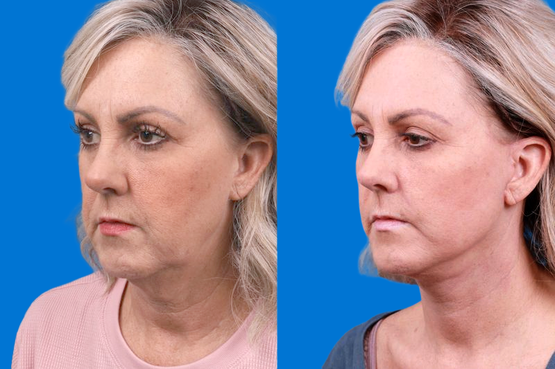 Facelift Before & After Gallery - Patient 147033236 - Image 4