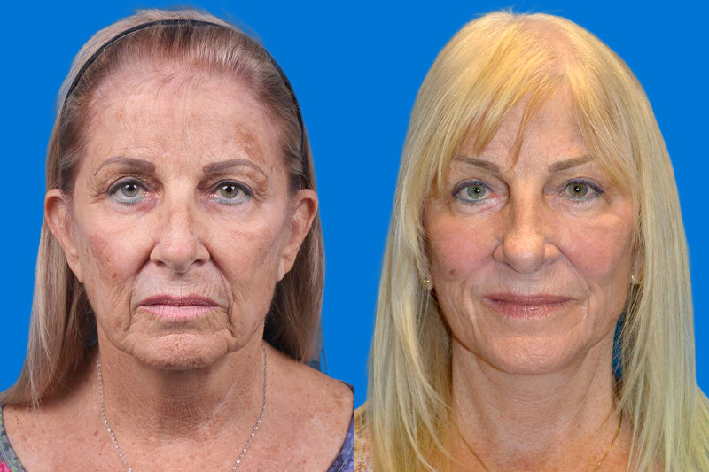 Nasolabial Folds Before & After Gallery - Patient 325201 - Image 1