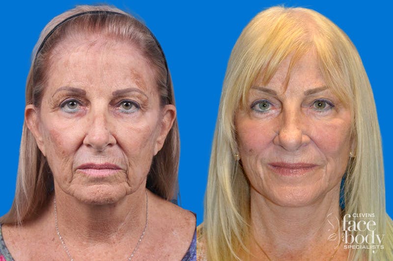 Facelift Before & After Gallery - Patient 148466777 - Image 1