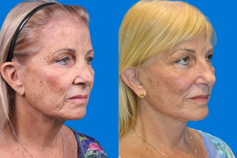 Facelift Before & After Gallery - Patient 148466777 - Image 2