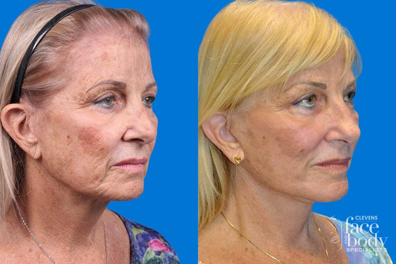 Facelift Before & After Gallery - Patient 148466777 - Image 2