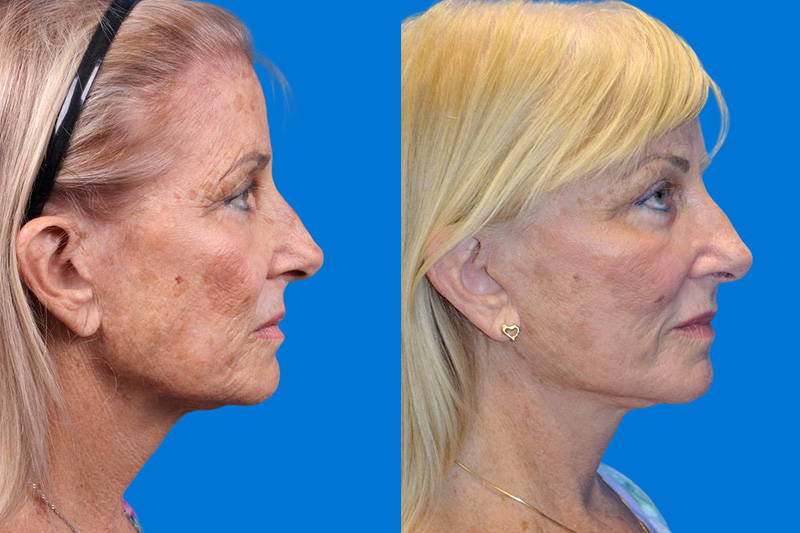 Facelift Before & After Gallery - Patient 148466777 - Image 3