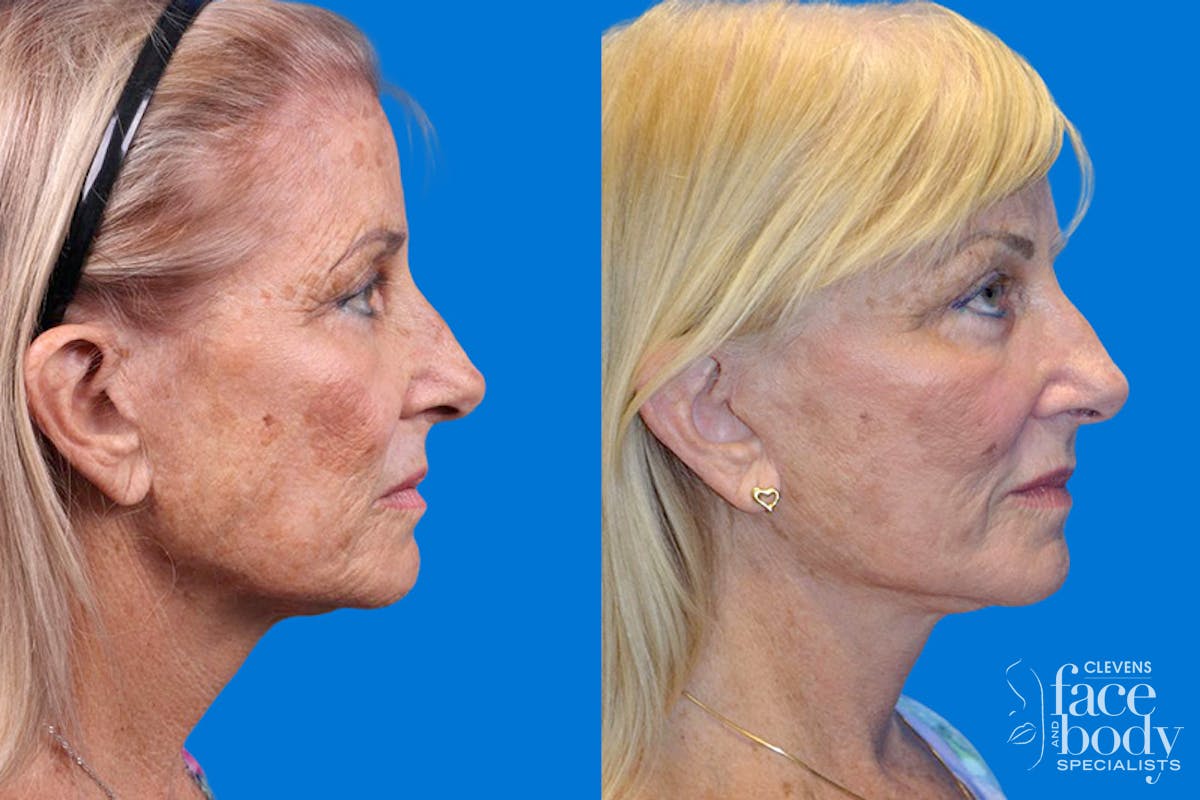 Facelift Before & After Gallery - Patient 148466777 - Image 3