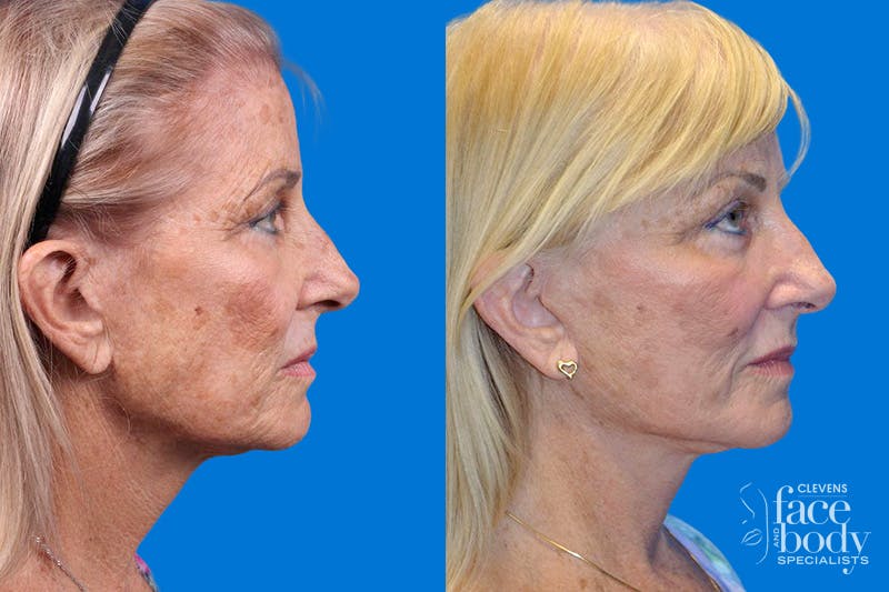 Facelift Before & After Gallery - Patient 148466777 - Image 3
