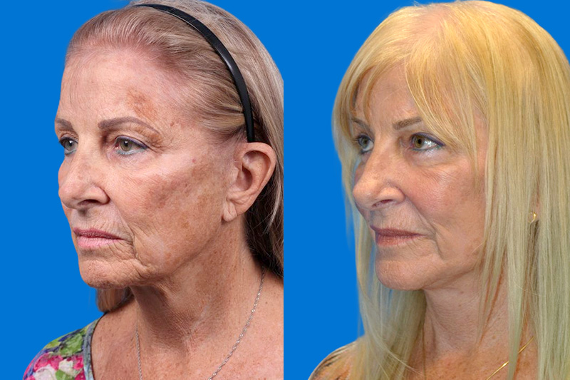 Facelift Before & After Gallery - Patient 148466777 - Image 4
