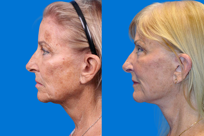 Facelift Before & After Gallery - Patient 148466777 - Image 5