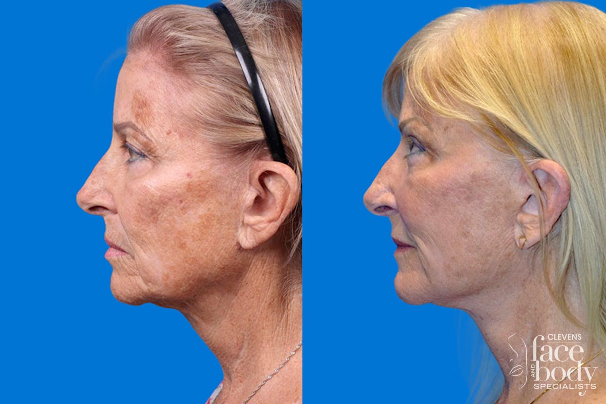 Facelift Before & After Gallery - Patient 148466777 - Image 5