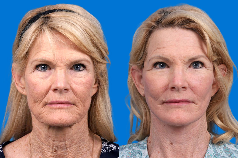Facelift Before & After Gallery - Patient 146900394 - Image 1