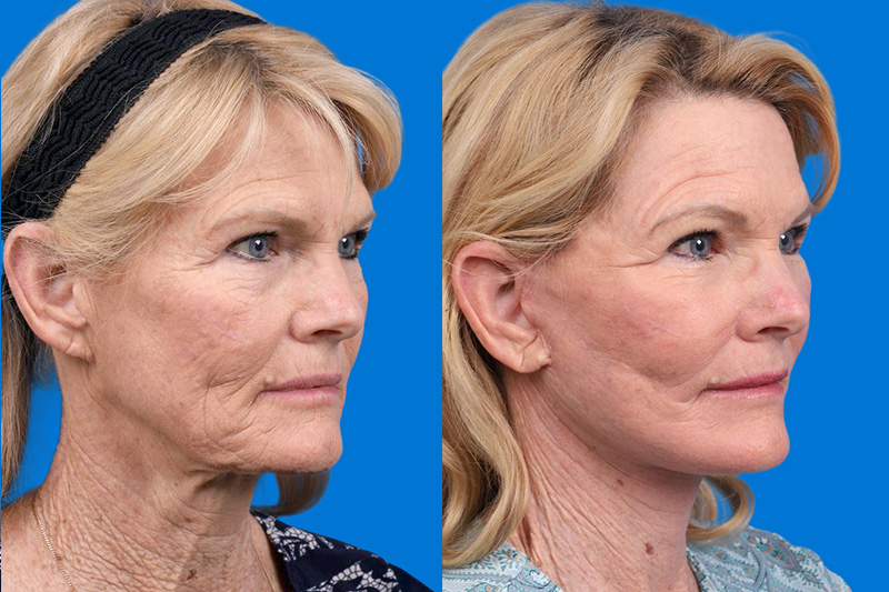 Facelift Before & After Gallery - Patient 146900394 - Image 2
