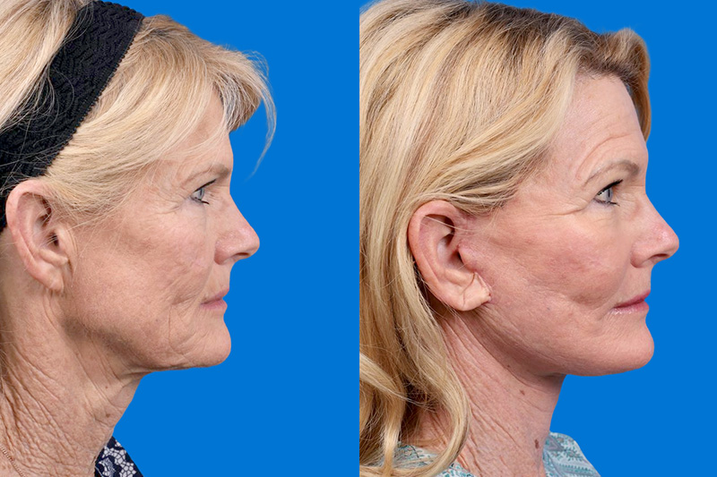 Facelift Before & After Gallery - Patient 146900394 - Image 3