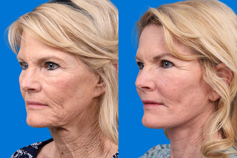 Facelift Before & After Gallery - Patient 146900394 - Image 4