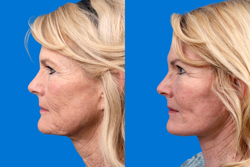Facelift Before & After Gallery - Patient 146900394 - Image 5