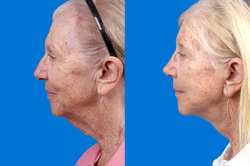 Nasolabial Folds Before & After Gallery - Patient 249393 - Image 5