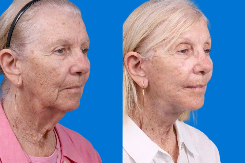 Nasolabial Folds Before & After Gallery - Patient 249393 - Image 2