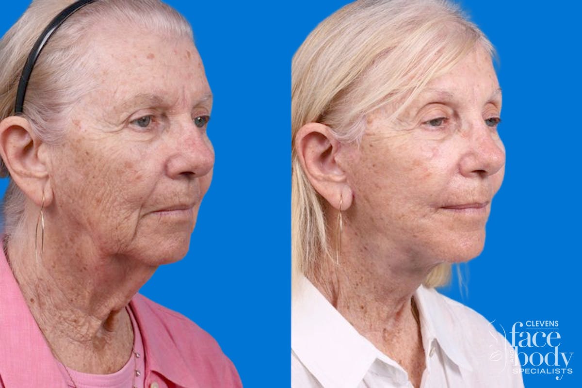 Rhinoplasty Before & After Gallery - Patient 110327 - Image 2