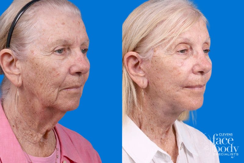 Rhinoplasty Before & After Gallery - Patient 110327 - Image 2