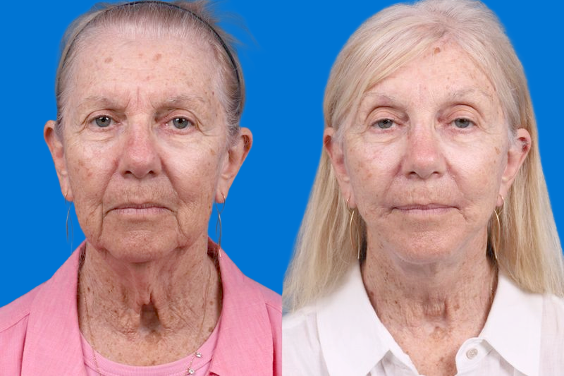 Eyelid Surgery Before & After Gallery - Patient 280363 - Image 1