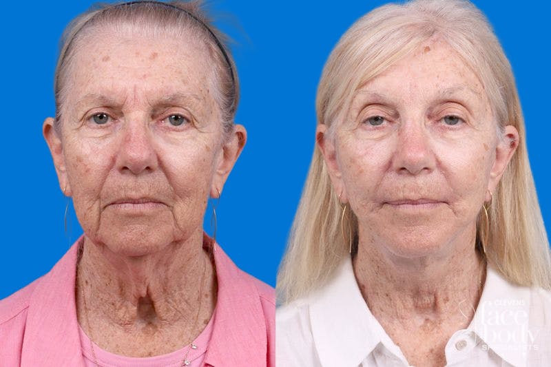 Rhinoplasty Before & After Gallery - Patient 110327 - Image 1