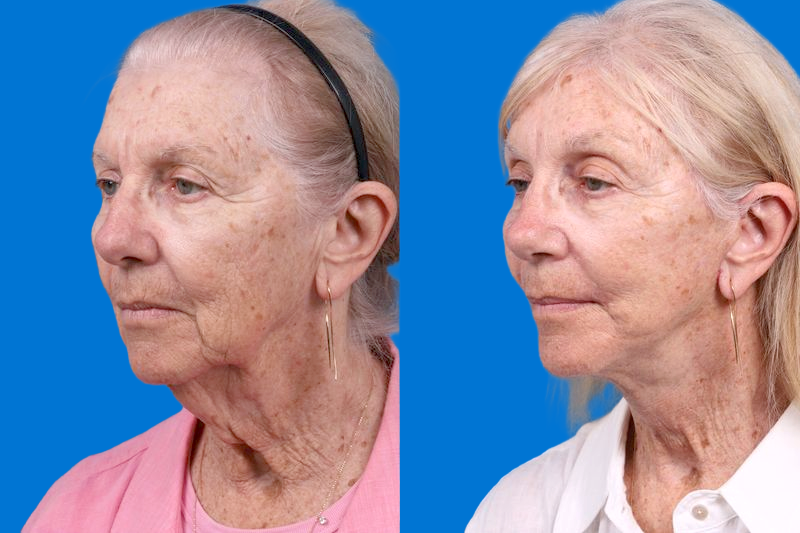Nasolabial Folds Before & After Gallery - Patient 249393 - Image 4