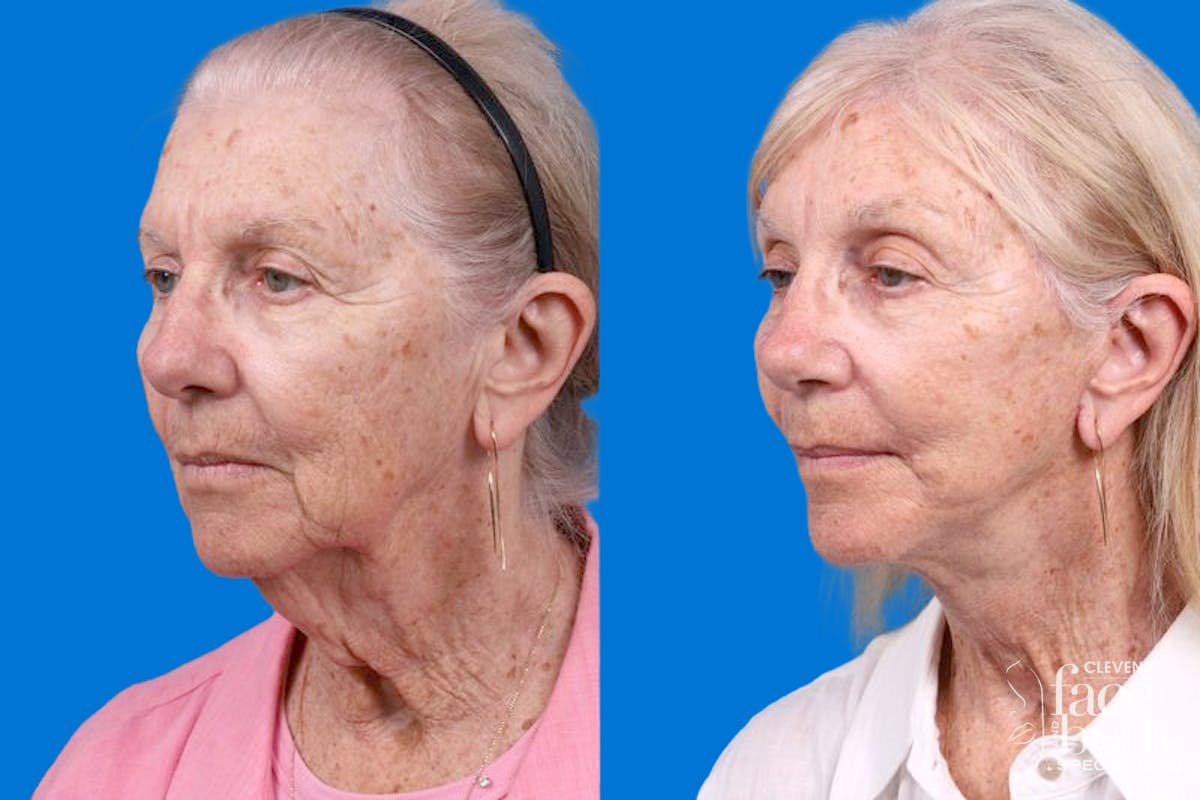 Rhinoplasty Before & After Gallery - Patient 110327 - Image 4