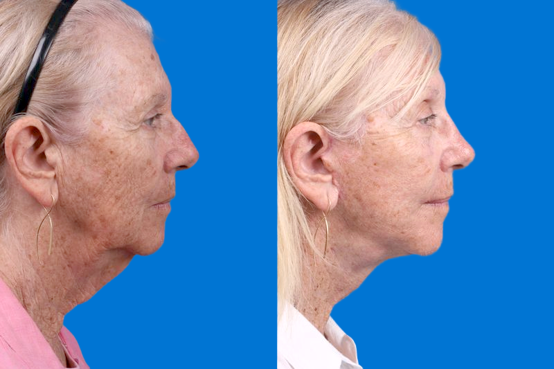 Nasolabial Folds Before & After Gallery - Patient 249393 - Image 3
