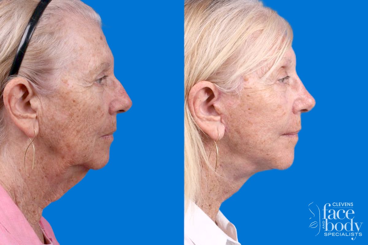 Rhinoplasty Before & After Gallery - Patient 110327 - Image 3