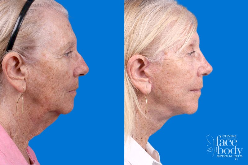 Rhinoplasty Before & After Gallery - Patient 110327 - Image 3