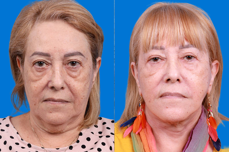 Facelift Before & After Gallery - Patient 149464005 - Image 1
