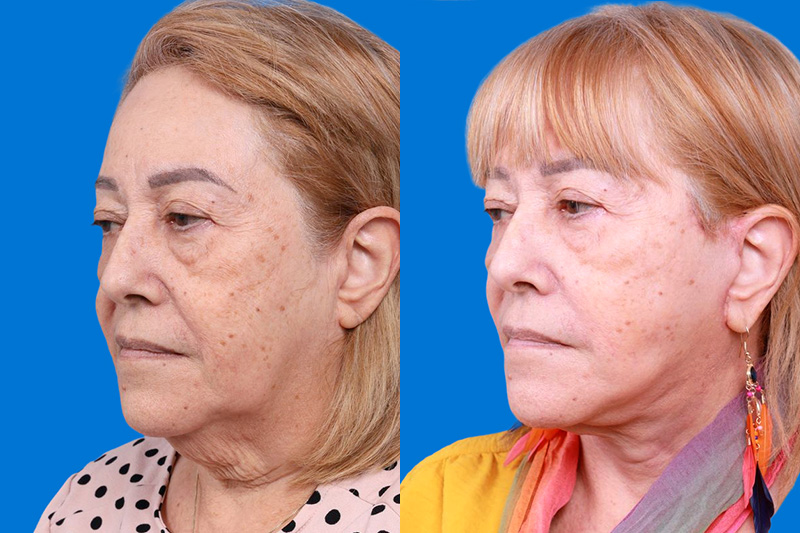 Facelift Before & After Gallery - Patient 149464005 - Image 4