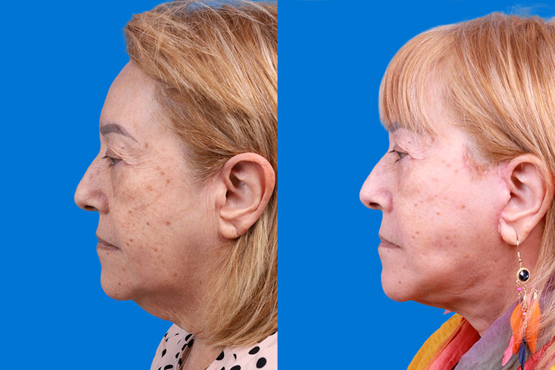 Facelift Before & After Gallery - Patient 149464005 - Image 5