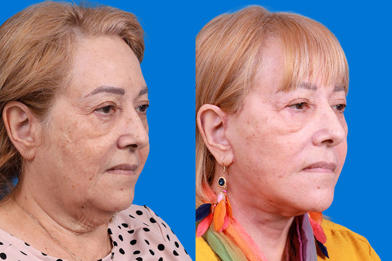 Facelift Before & After Gallery - Patient 149464005 - Image 2