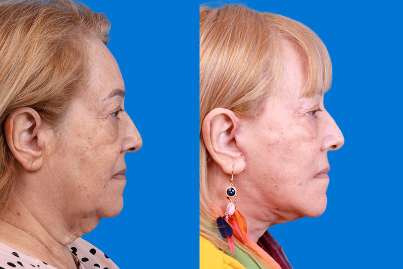Facelift Before & After Gallery - Patient 149464005 - Image 3
