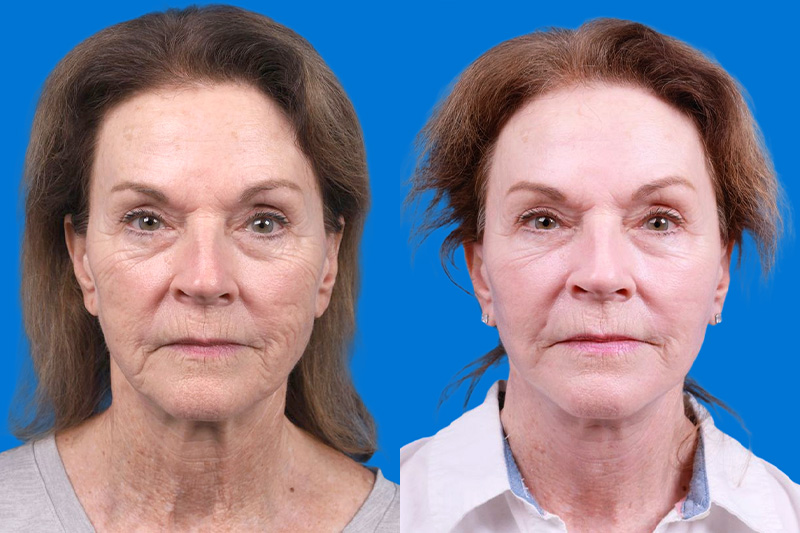 Skin Resurfacing Before & After Gallery - Patient 118477 - Image 1