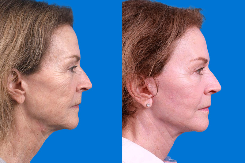 Skin Resurfacing Before & After Gallery - Patient 118477 - Image 3