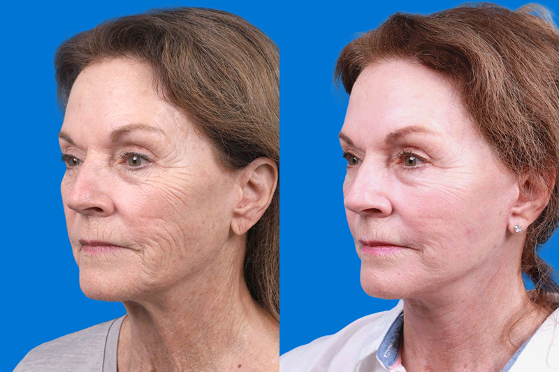 Skin Resurfacing Before & After Gallery - Patient 118477 - Image 4