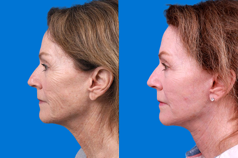 Skin Resurfacing Before & After Gallery - Patient 118477 - Image 5