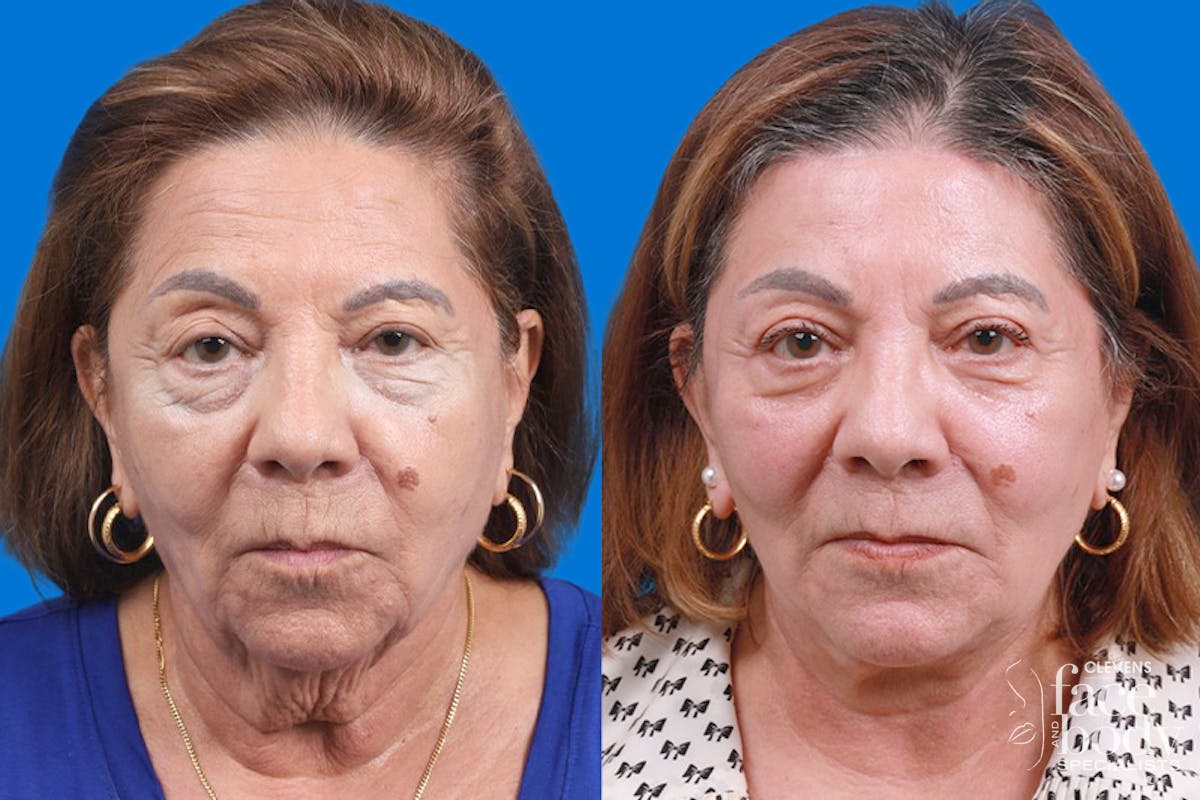 Eyelid Surgery Before & After Gallery - Patient 194128 - Image 1