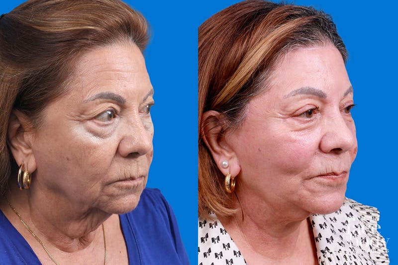 Eyelid Surgery Before & After Gallery - Patient 194128 - Image 2