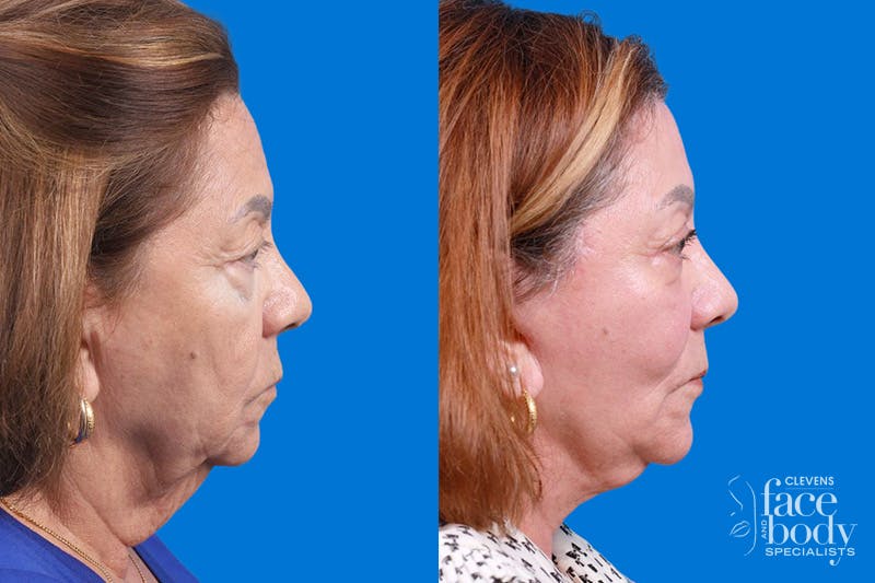 Eyelid Surgery Before & After Gallery - Patient 194128 - Image 3