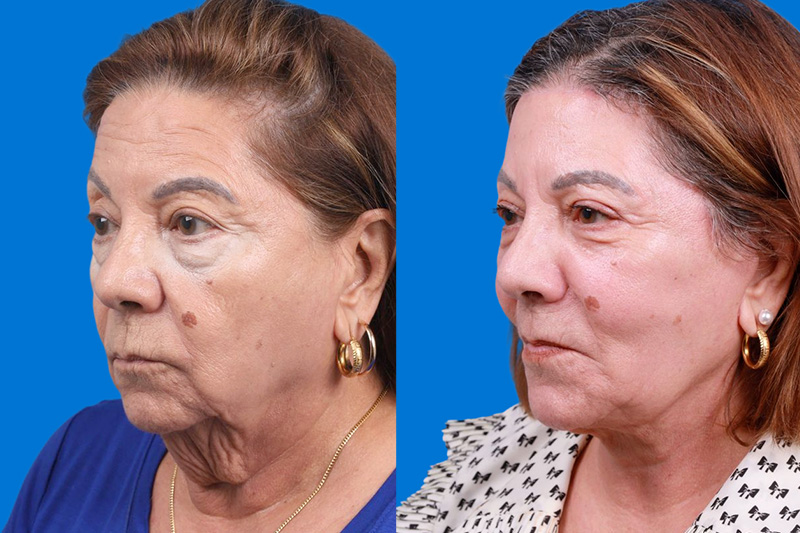 Nasolabial Folds Before & After Gallery - Patient 416782 - Image 4